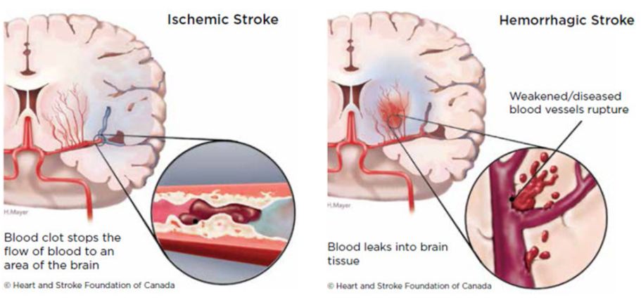 Effects of Stroke - Milka Clarke Stroke Brain Trauma Foundation